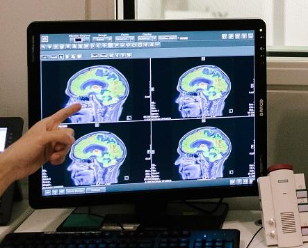 MRI brain imaging displayed on a computer screen